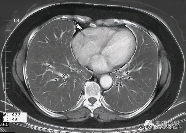 CT斷層解剖圖譜最全總結「推薦收藏」 CT斷層解剖圖譜最全總結「推薦收藏」