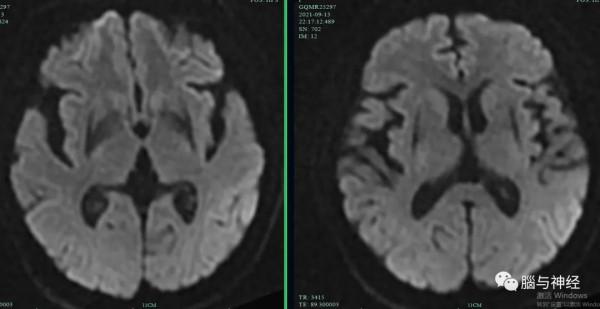 多系統萎縮，我是得了帕金森病嗎？