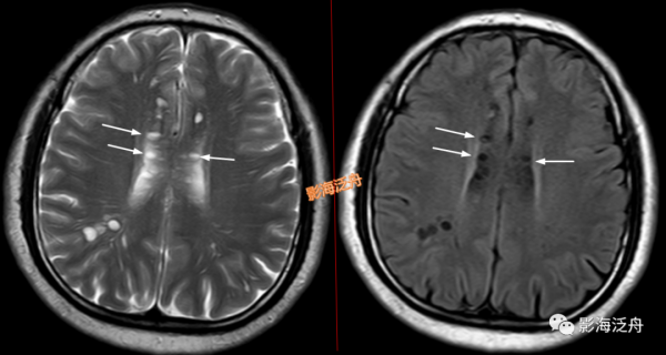 VR腔隙、腔梗灶、微出血、脫髓鞘，傻傻分不清？快看這裡