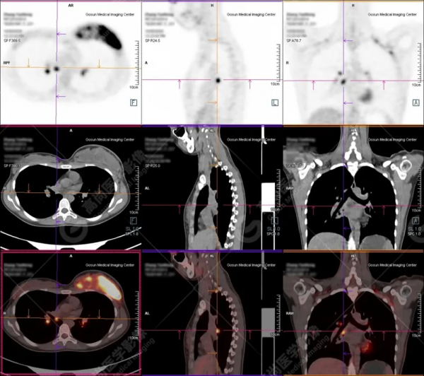 PET/CT病例（3）：別因害羞不願就診而延誤診斷——青年乳腺癌