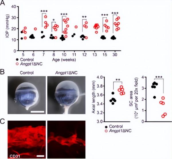 扭轉先天性青光眼解剖學缺陷 降眼壓效果持久 開闢青光眼治療新賽道