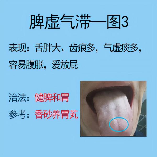 脾胃不好常見6種舌象，比如脾氣虛，脾陽虛等，後面有解決方法