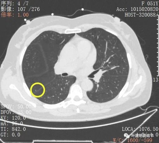 指南說小於5毫米的肺結節不需要隨訪，打臉來了