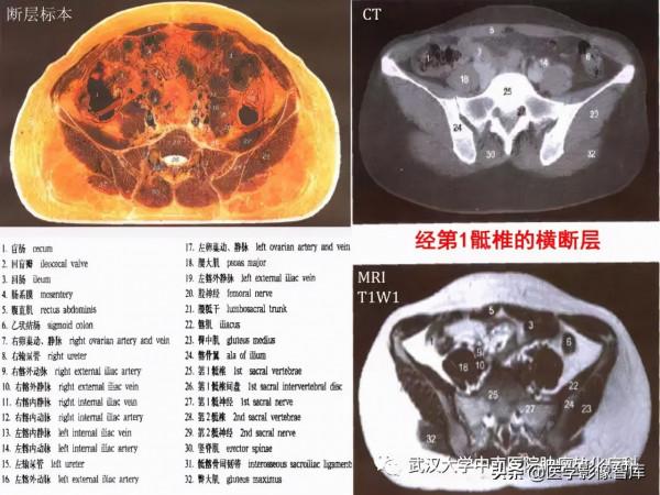 CT斷層解剖圖譜最全總結「推薦收藏」 CT斷層解剖圖譜最全總結「推薦收藏」