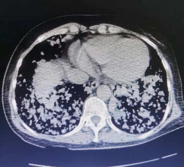 天啊！這個肺千瘡百孔，到底怎麼了？原來是肺轉移癌