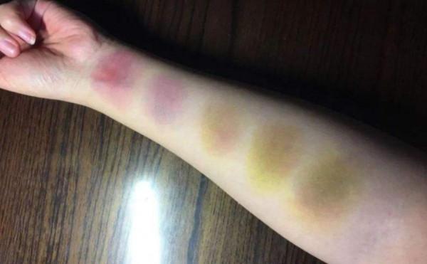 淤青真不是&OpenCurlyDoubleQuote;鬼&rdquo;掐的，身體的&OpenCurlyDoubleQuote;求救訊號&rdquo;要留心
