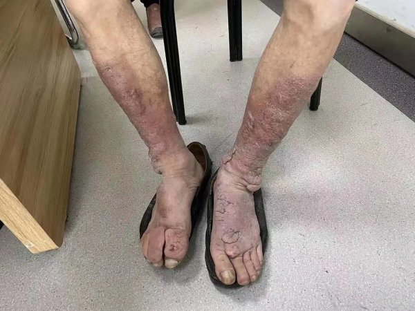 碘131治療甲亢後成甲減，出現嚴重的併發症，如何避免併發症？