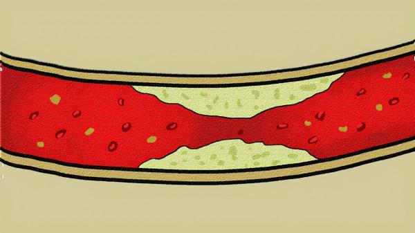 當血管內有血栓堵塞時，身體可能會有這3個部位發麻，別大意