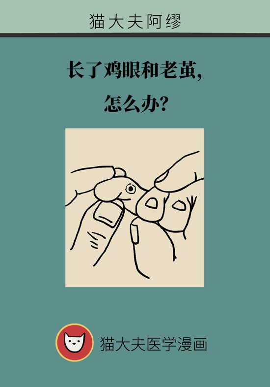 長了雞眼和老繭怎麼辦？這份防治指南請收好