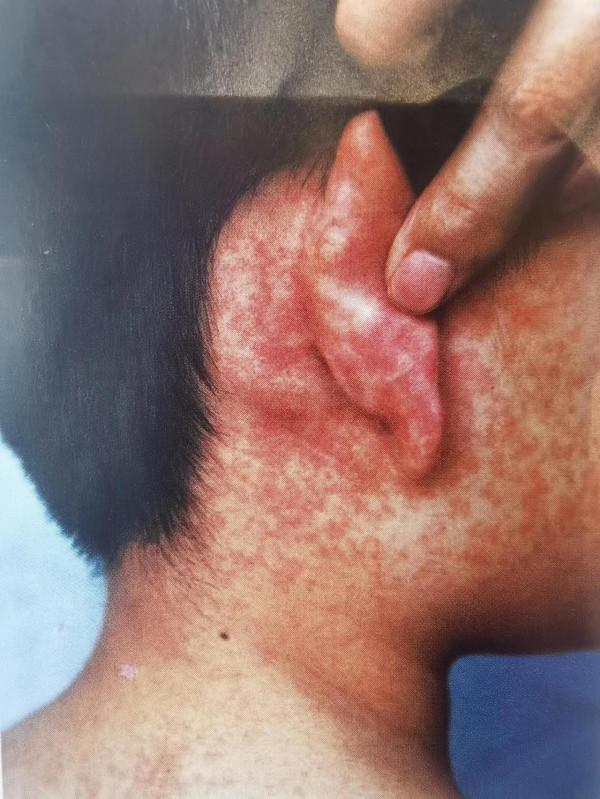 風疹怎麼治療 風疹是什麼