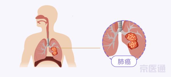 結節、肺炎、肺癌……5大肺病，專家一次說清