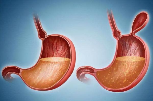 世衛組織呼籲：停止食用3個“高鹽大戶”，常吃或讓胃受損