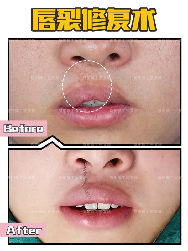 唇裂二期最佳手術時間是什麼時候?嘴唇怎樣才算是效果好? 唇裂二期最佳手術時間是什麼時候?嘴唇怎樣才算是效果好?