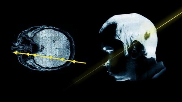 被高能粒子爆頭會怎樣？科學家：一道閃光之後，左臉永久癱瘓