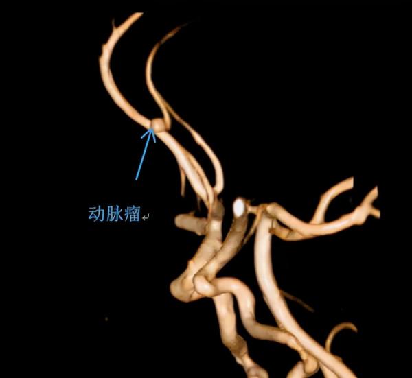 凌晨急診，13個月寶寶摔倒兩天後突然抽搐