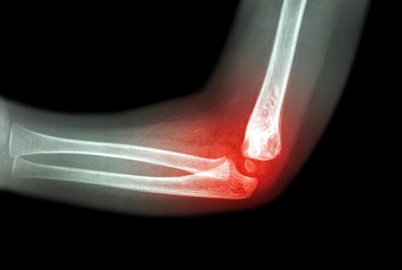 三種類風溼，醫生都頭疼