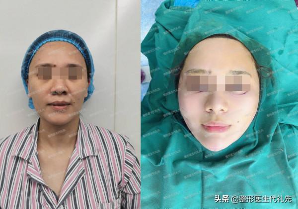 微創小切口面部提升+面部脂肪,朋友說術後看著能年輕上至少10歲 微創小切口面部提升+面部脂肪,朋友說術後看著能年輕上至少10歲