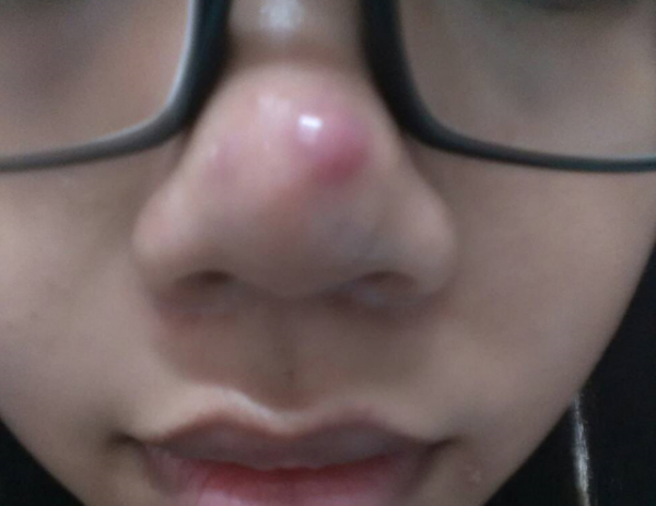 鼻頭長痘痘又紅又腫是什麼原因？