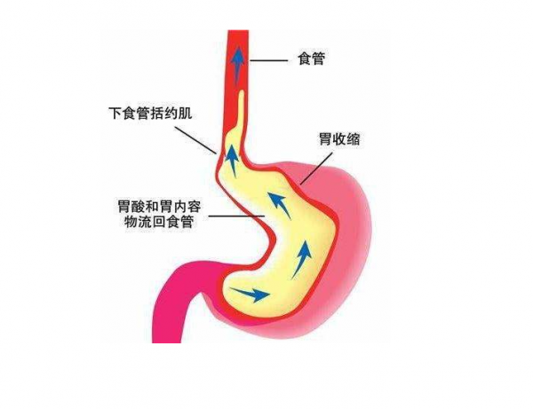 胃食管反流病患者應當如何注意飲食？