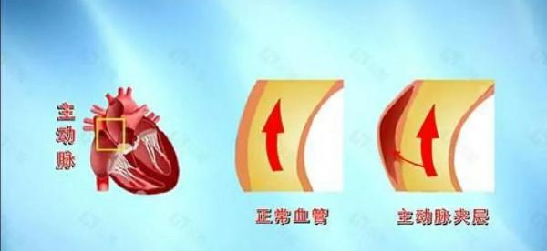 男子腹痛嘔血，以為胃潰瘍，確診時醫生冒汗：這病幾分鐘就可致命