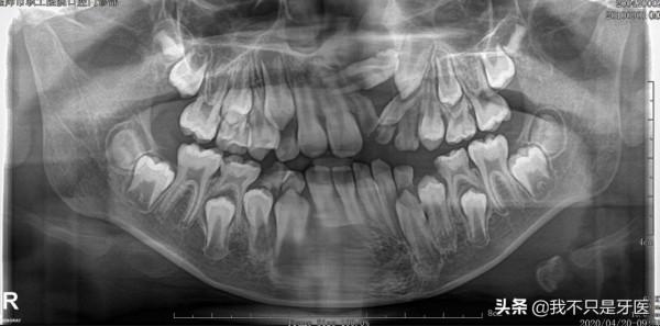 孩子替牙期，牙醫讓給孩子拍一張“曲面斷層片”，不是為了掙你錢