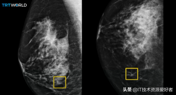 能檢測乳腺癌,還能讓漸凍症患者“開口說話”,谷歌這次有點東西 能檢測乳腺癌,還能讓漸凍症患者“開口說話”,谷歌這次有點東西