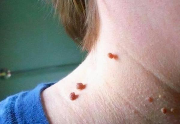 脖子上長了“小肉粒”，礙事嗎？要不要治療？醫生說明白了