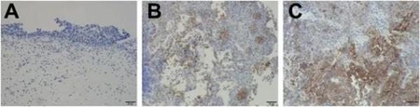 免疫治療療效長達2年多，化療後PD-L1表達水平或預測療效 &vert; 膀胱癌實踐病例
