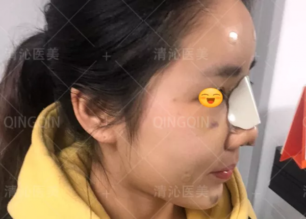 鼻子大變樣,她只用了一個月 鼻子大變樣,她只用了一個月