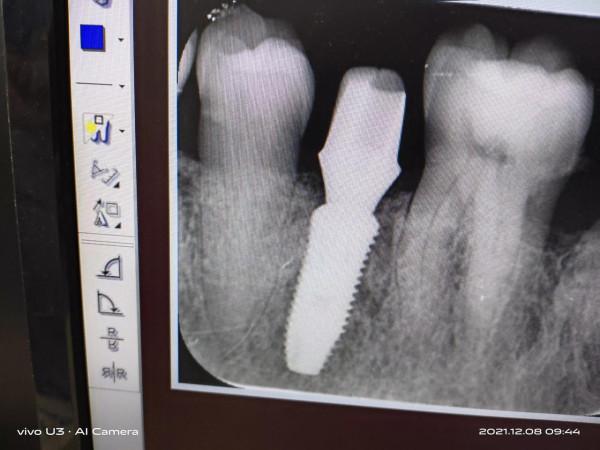 成功種上一顆牙