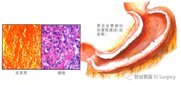 什麼是Borrmann IV型（瀰漫型）胃癌？