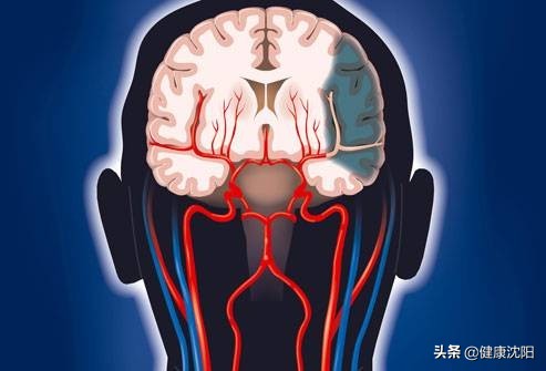 健康科普堂 | 健康生活，預防卒中