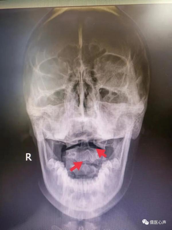 眩暈是中老年人的專屬病？不，年輕人甚至孩子也不少見