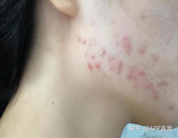 使用了2%水楊酸後面部肌膚泛紅?這是正常現象 使用了2%水楊酸後面部肌膚泛紅?這是正常現象