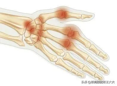什麼是痛風性關節炎?診斷依據是什麼?這個方子可調 什麼是痛風性關節炎?診斷依據是什麼?這個方子可調