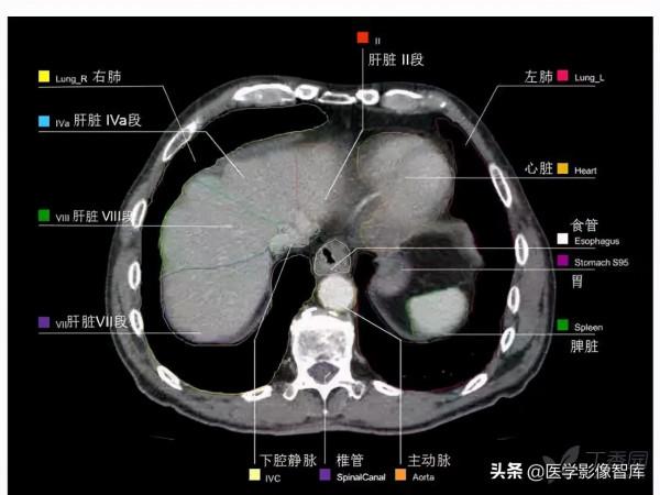 CT斷層解剖圖譜最全總結「推薦收藏」 CT斷層解剖圖譜最全總結「推薦收藏」
