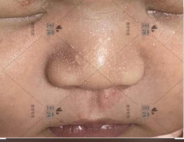 新生兒一過性面板病（上）