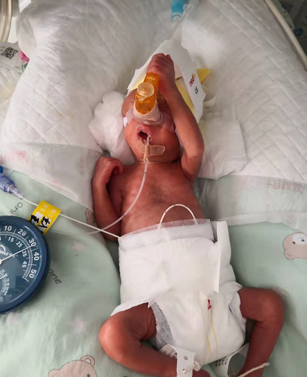 一斤多重的超早產兒剛出生，就插滿管子進了保溫箱！出院時，爸媽都哭了