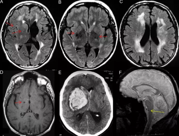 磁共振上出現腦微出血,這11種病因要考慮 磁共振上出現腦微出血,這11種病因要考慮
