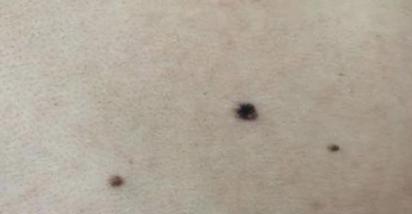 醫生提醒：若黑痣長在這4個部位，要密切關注，及早做檢查
