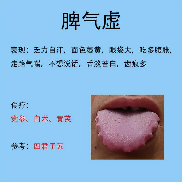 脾胃不好常見的六種舌象,和臨床表現分享,後帶解決方法 脾胃不好常見的六種舌象,和臨床表現分享,後帶解決方法