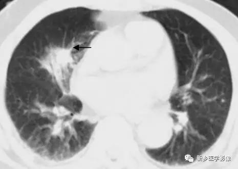 肺部5大基本病變,影像診斷的基礎 肺部5大基本病變,影像診斷的基礎