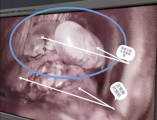 肺大泡相關（診治）問題