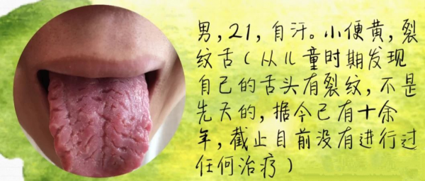 舌頭有裂紋是怎麼回事?常見的裂紋舌辯證,看看你是哪一種? 舌頭有裂紋是怎麼回事?常見的裂紋舌辯證,看看你是哪一種?