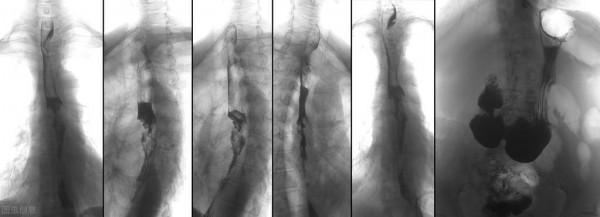 食管癌：最高發的省是哪裡？四川僅排第二！當地人都有這個習慣