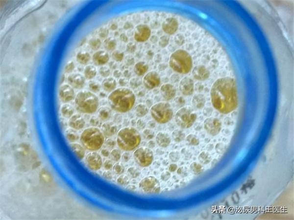 有泡沫尿就是腎臟有問題嗎? 有泡沫尿就是腎臟有問題嗎?