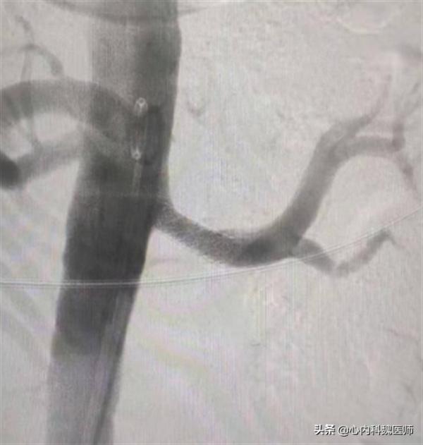 每天吃沙坦類降壓藥,忽略這2點,等於白吃藥,還可能有風險 每天吃沙坦類降壓藥,忽略這2點,等於白吃藥,還可能有風險