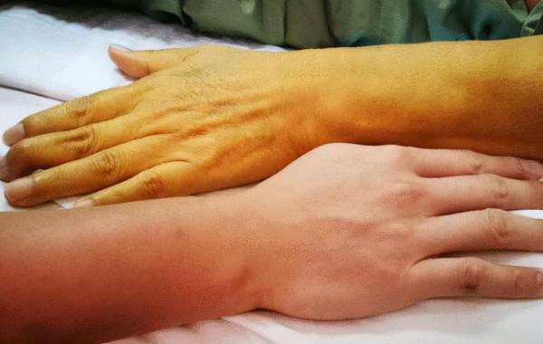 如果出現這些症狀，可能你的肝臟出了問題