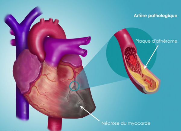 吲哚布芬，抗血小板兼抗凝，舒張血管、減輕炎症，防治心腦腎缺血