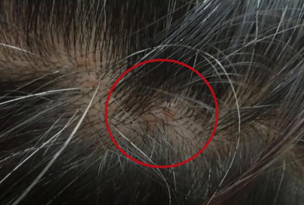 為什麼頭皮總長“疙瘩”和“膿包”？或與4個原因有關